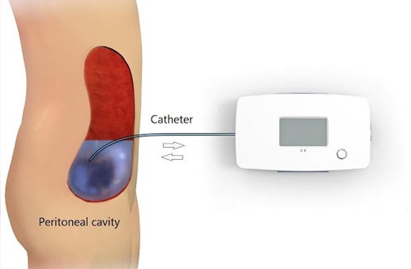 peritoneal-dialysis-portable-and-wearable-nanodialysis